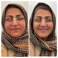 اندولیفت صورت و بدن با دستگاه یوفوتون ایتالیا|خدمات آرایشگری و زیبایی|کرج, شهرک مترو|دیوار