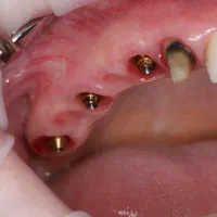 ایمپلنت فوری/دندانپزشکی با اقساط۶-۱۵ماهه