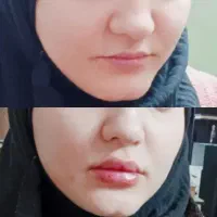 تزریق ژل وبوتاکس ژل لب گونه چانه زاویه خط لبخند|خدمات آرایشگری و زیبایی|کرمانشاه, |دیوار