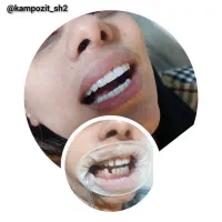 آف ویژه خدمات تخصصی کامپوزیت دندان|خدمات آرایشگری و زیبایی|شاهین‌شهر, فردوسی|دیوار