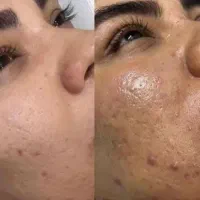پاکسازی سوپرفشیال تخصصی، مطب ویژه آقایان وبانوان|خدمات زیبایی و سلامت|تهران, نارمک|دیوار