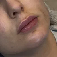 تزریق فیلر لب چانه زاویه فک گونه شقیقه بوتاکس|خدمات آرایشگری و زیبایی|قزوین, |دیوار