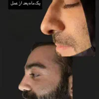 قسطی جراحی بینی و پیکرتراشی و لیفت صورت و ژل|خدمات آرایشگری و زیبایی|تبریز, |دیوار