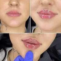 جشنواره ژل لب چانه زاویه جوانسازی بوتاکس لیفت|خدمات آرایشگری و زیبایی|تهران, گیشا|دیوار