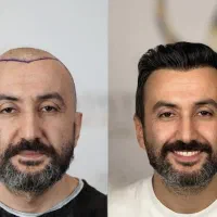 کاشت مو‌ ابرو بدون جراحی ضمانت نامه مادام العمر