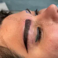کاشت مو کاشت ابرو
