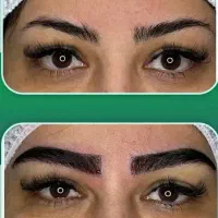 کاشت ابروفقط ۱۰ میلیون کاشت مو ۲۵