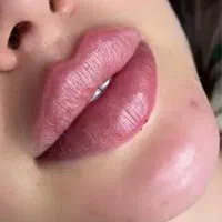 تزریق ژل و بوتاکس|خدمات آرایشگری و زیبایی|تهران, عبدل‌آباد|دیوار
