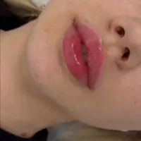 تخفیفات ژل و بوتاکس در مطب پزشک|خدمات آرایشگری و زیبایی|سنندج, |دیوار