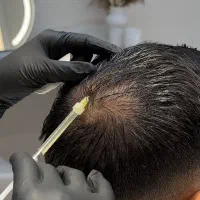 مزوتراپی تخصصی مو/کاهش ریزش و تقویت رشد