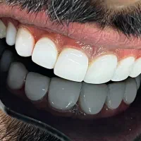 عصب‌کشی با ترمیم فقط ۴/۵ م/ جشنواره دندان‌پزشکی