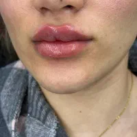 تزریق فیلر نورامیس صورت لب|خدمات آرایشگری و زیبایی|تهران, تهرانسر مرکزی|دیوار