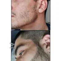 پر پشتی رویش تضمینی