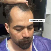 کاشت ابرو مو ریش|خدمات آرایشگری و زیبایی|گرگان, |دیوار