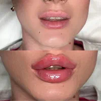 لیفت صورت نخ،ژل لب بوتاکس هایفو لیزر موتیتانیومprp|خدمات آرایشگری و زیبایی|مشهد, وکیل‌آباد|دیوار
