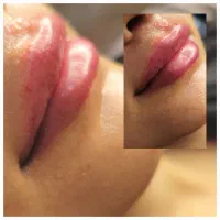 ژل بوتاکس بلفارو پلاستی لیزر|خدمات آرایشگری و زیبایی|اهواز, اهواز|دیوار