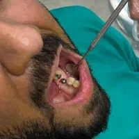 عصب کشی کانالی ۲/۵۰۰ روکش دندان در شرق تهران|خدمات زیبایی و سلامت|تهران, چهارصد دستگاه|دیوار
