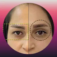 عمل بلفارو وتزریق بوتاکس فیلر وچربی وساکشن غبغب