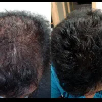 جشنواره یلدایی کاشت مو ، ابرو و مزوتراپی و prp|خدمات آرایشگری و زیبایی|زنجان, |دیوار