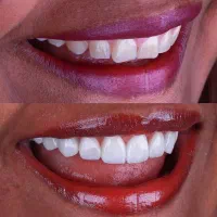 تخفیف‌های ویژه دندانپزشکی عکس تمام فک رایگان