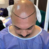 کاشت مو پر تراکم|خدمات آرایشگری و زیبایی|جهرم, |دیوار