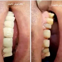 ساخت انواع دندان