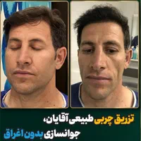 تزریق چربی بوکال فت کاشت مو ساکشن غبغب بلفاروپلاسی|خدمات آرایشگری و زیبایی|اصفهان, ملک‌شهر|دیوار