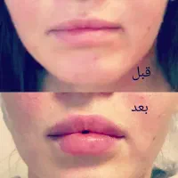 بمب تخفیف تزریق ژل و فیلر و اگزوزوم|خدمات آرایشگری و زیبایی|شیراز, نصر|دیوار