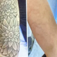 ریموو انواع تتو خالکوبی صورت بدن بالیزر درکلینیک