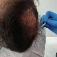 خدمات زیبایی بوتاکس ، ژل ،مزوتراپی، ریمو تتو هایفو|خدمات آرایشگری و زیبایی|فولادشهر, B2|دیوار
