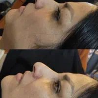 تزریق ژل و بوتاکس مزو تراپی جوانسازی تخلیه میلیا|خدمات آرایشگری و زیبایی|مشهد, ثامن|دیوار