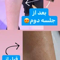۲۰ درصد تخفیف لیزر کل بدن از طرف دیوار|خدمات آرایشگری و زیبایی|گرگان, |دیوار