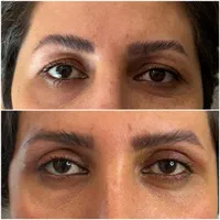 عمل(افتادگی پلک بالا و پایین )عمل زیبایی( گوش)