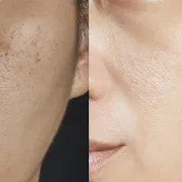 فیشیال تخصصی ، جوانسازی ، پاکسازی ، فیشال صورت