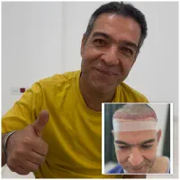 کاشت مو یا معجزه.خط رویش طبیعی تراکم بالا تضمینی|خدمات آرایشگری و زیبایی|یزد, |دیوار