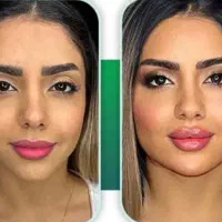 بوتاکس ژل لب گونه چانه فک پر کردن صورت لاغر نخ مزو|خدمات آرایشگری و زیبایی|قم, زنبیل آباد|دیوار