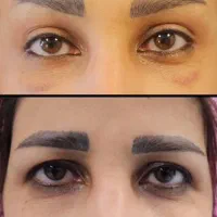 بلفارو،اتوپلاسی،تزریق چربی،سانترال،