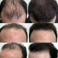کف دستت هم بزنی مو در میاره