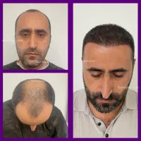 تخفیف ۱۲ میلیون تومانی روی کاشت مو