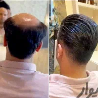 پروتز مو وارداتی ،کاشت hrt|خدمات آرایشگری و زیبایی|اصفهان, گلزار|دیوار
