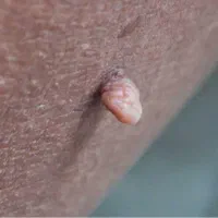 زگیلhpv