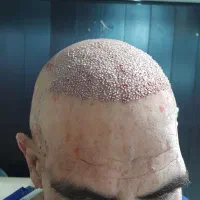 کاشت مو / ریش|خدمات آرایشگری و زیبایی|خرمآباد, |دیوار