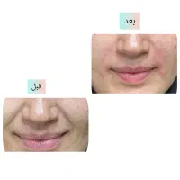 جشنواره تزریق ژل بدون درد و کبودی تضمینی|خدمات آرایشگری و زیبایی|جیرفت, |دیوار