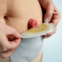 پرستار تخصصی مراقبت از استومی