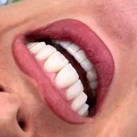 کامپوزیت لمینت پروتز متحرک اقساط ۱۲ ماه