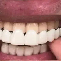 لمینت متحرک دندان اورجینال فک بالا پایین موجود