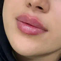 ژل و بوتاکس در کلینیک زیر نظرپزشک با تخفیف ویژه