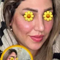 ژل ، بوتاکس ، چربی ، فیلر|خدمات آرایشگری و زیبایی|کرمانشاه, |دیوار