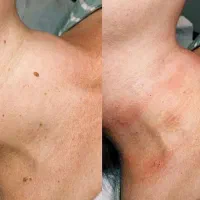 خال خالبرداری لیپوم غده چربی میخچه میلیا تگ پوستی|خدمات آرایشگری و زیبایی|تهران, صادقیه|دیوار