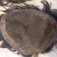 پروتز مو مردانه